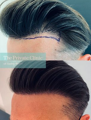 fue hair transplant before and after photo showing results fue-hair-transplant-before-after-photos-results-side-dr-furqan-raja-006FR