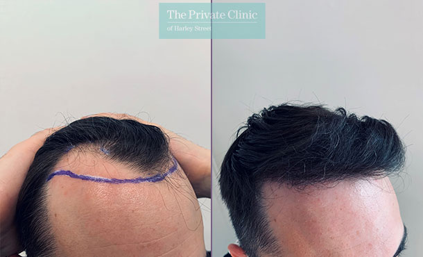 FUE Hair Transplant - 009FR - Side