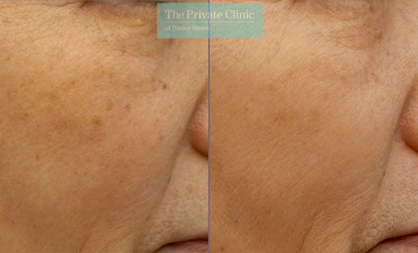 ipl photorejuvenation treatment before and after images showing reduction in pigmentation and sun spots