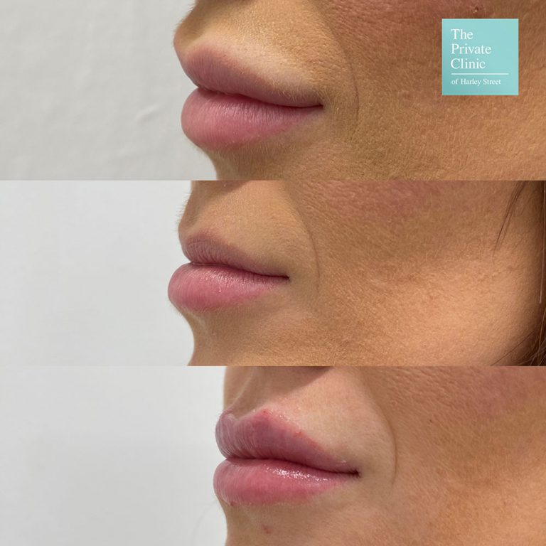 Dermal Filler removal before and after, Removing Facial Fillers, Dermal
