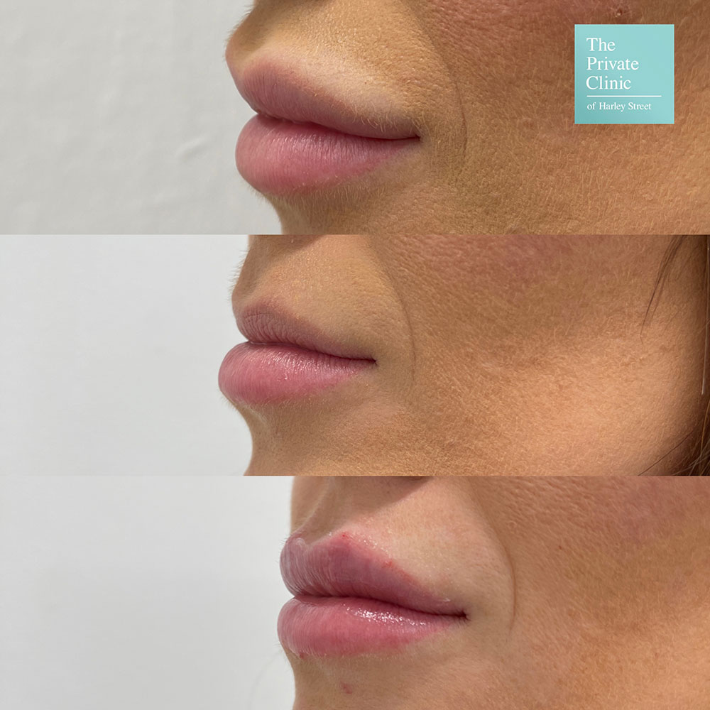 Dermal Filler removal before and after photo