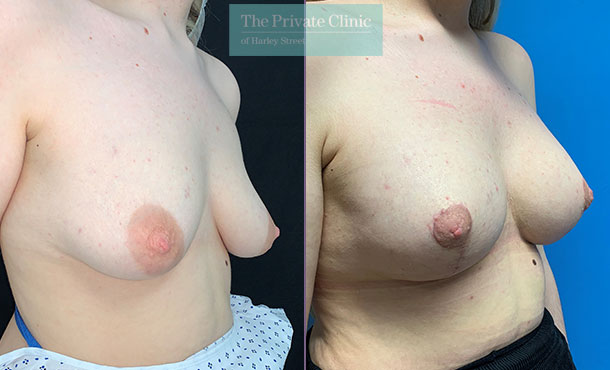 Breast Uplift with Implants before after photo