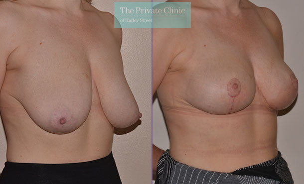 sagging breast fix surgery before after photos UK