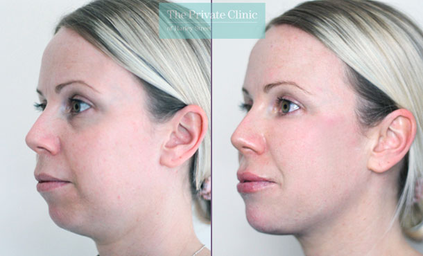 Non-Surgical Chin Augmentation-001CSC