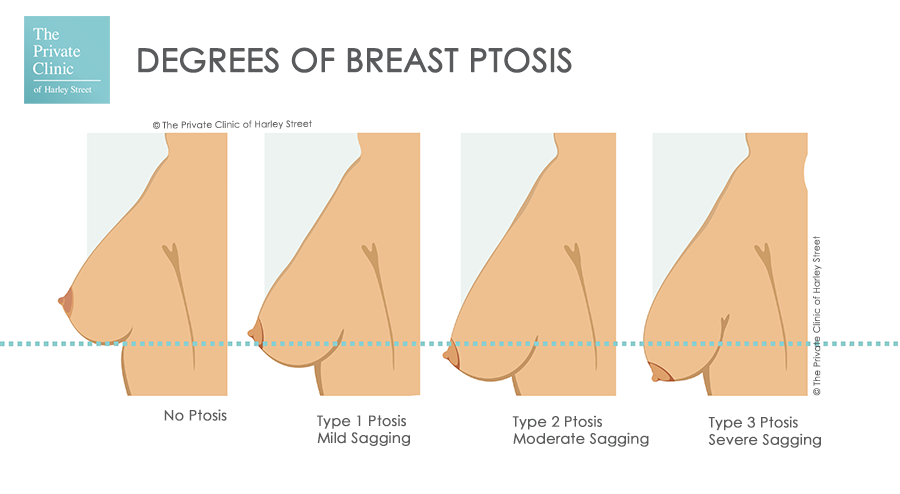 Breast ptosis degree