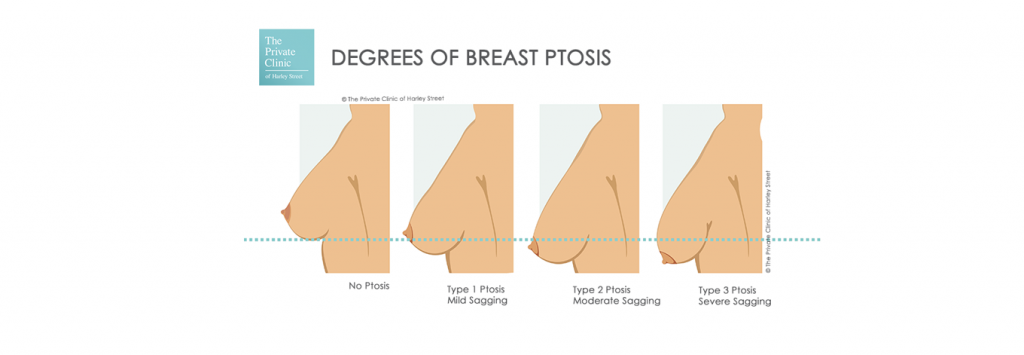 Sagging Breast Pics