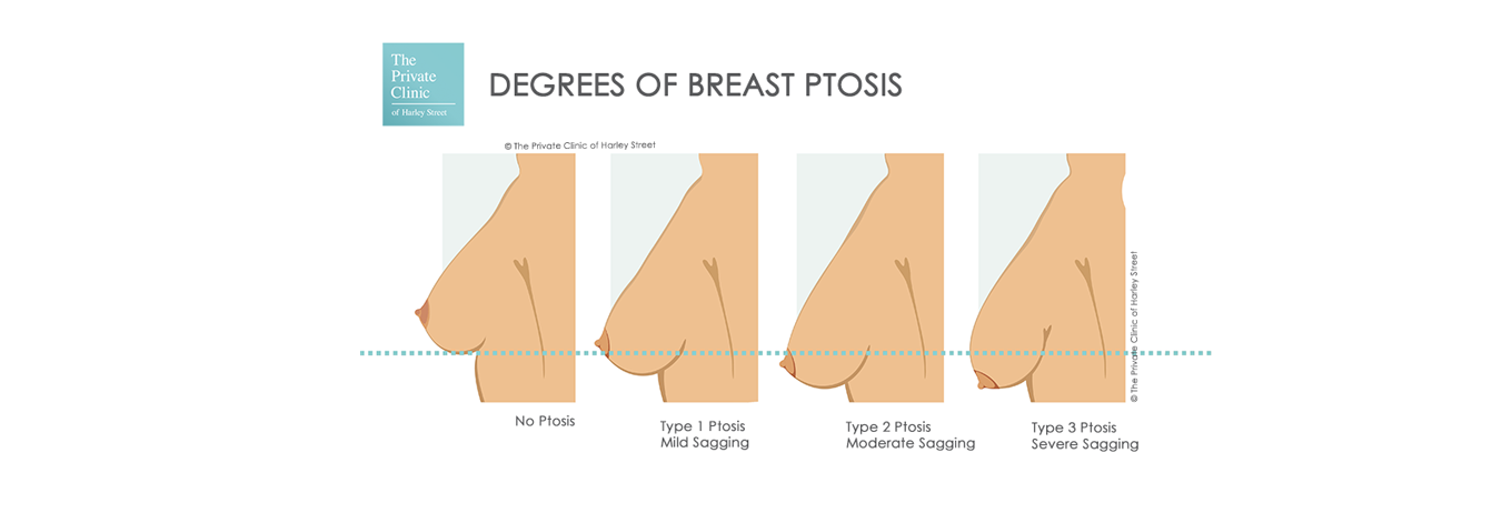 sagging breast fix surgery