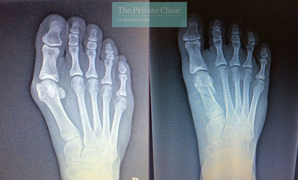 Bunion Surgery before after x-ray photo