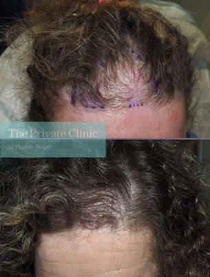 Hair Transplant Women, Thinning hair treatment, Hair Loss Female pattern