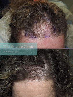 Female FUE Hair Transplant - 027MM