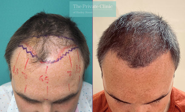 FUE Hair Transplant - 025MM