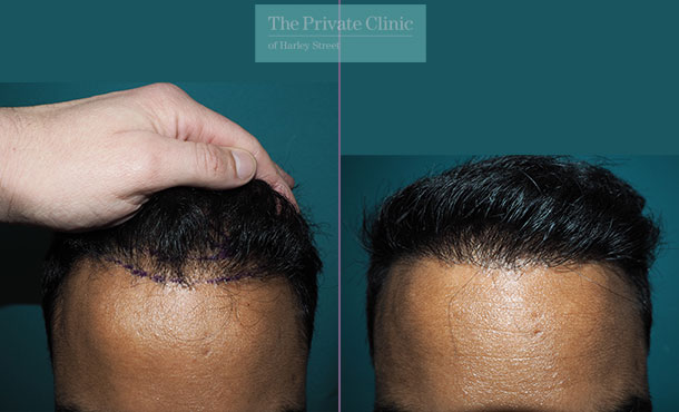 FUE Hair Transplant 026MM-Front