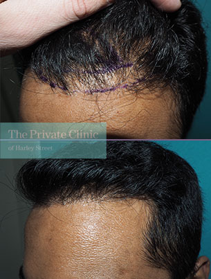 fue-hair-transplantation-before-after-photo-results-mr-michael-mouzakis-026MM-side fue-hair-transplantation-before-after-photo-results-mr-michael-mouzakis-026MM-side