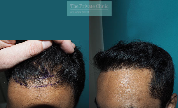 Hair Transplant Repair - 026MM-Side - The Private Clinic of Harley Street
