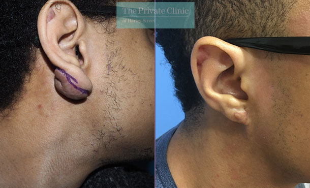 Keloid Removal 005P-MM