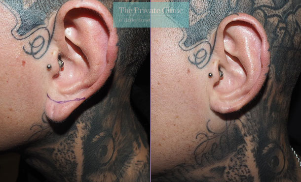 split-earlobes-reduction-repair-before-after-photos-results-mr-michael-mouzakis-right-001P-MM