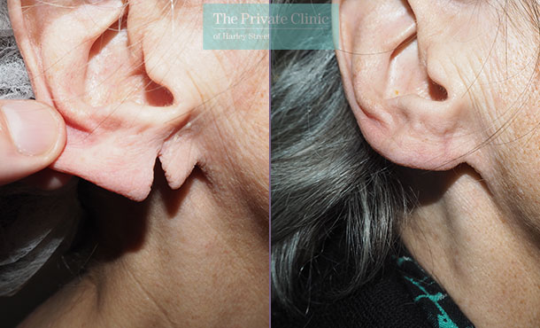 Earlobe Repair, Split Earlobe Surgery