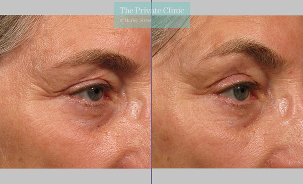 ultherapy browlift non surgical skin tightening manchester before after results