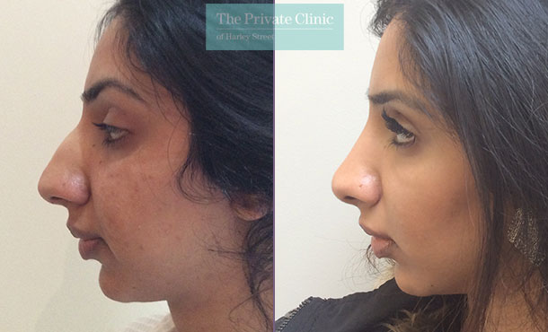 asian nose rhinoplasty before after photos results