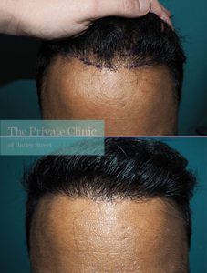 revision hair transplant UK before after photo