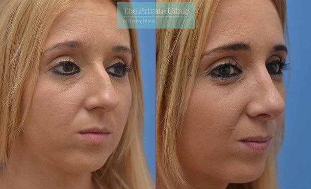 nose reshaping surgery female before after photos