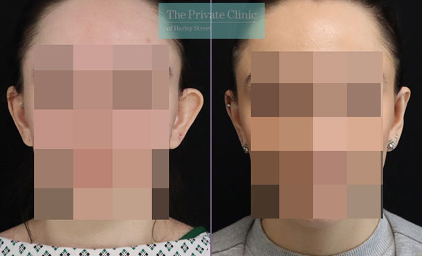 Otoplasty before and after results