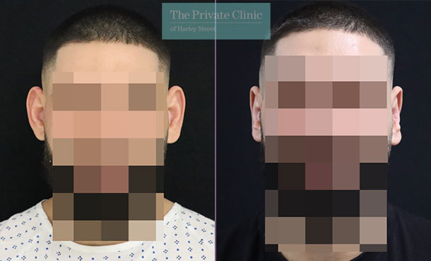 Otoplasty before and after results