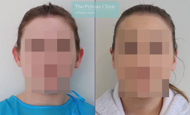 Otoplasty before and after results