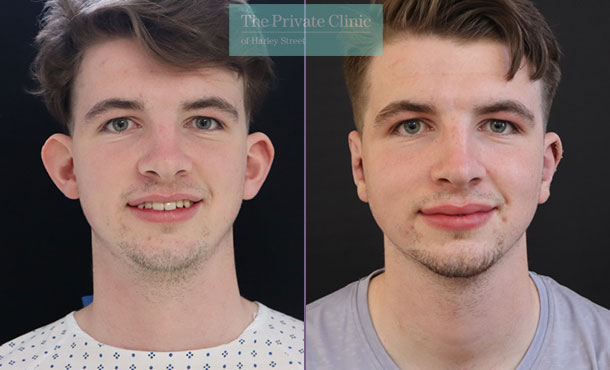 ear pinning surgery men before and after photos front