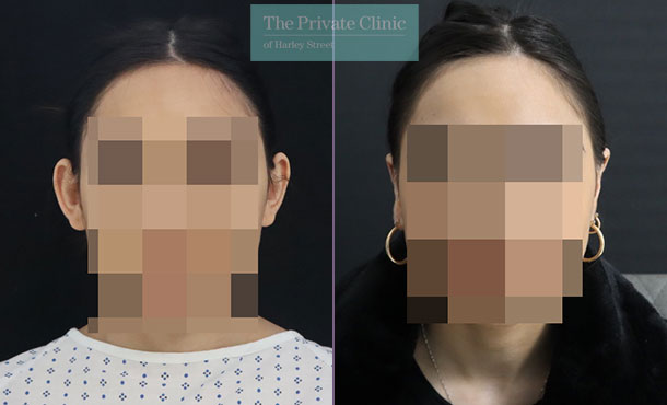 Otoplasty before and after results