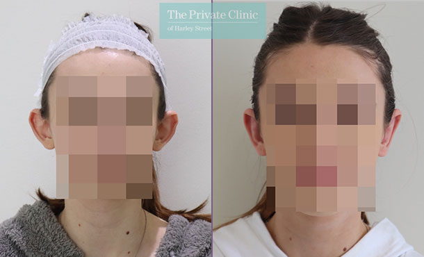 Otoplasty before and after results