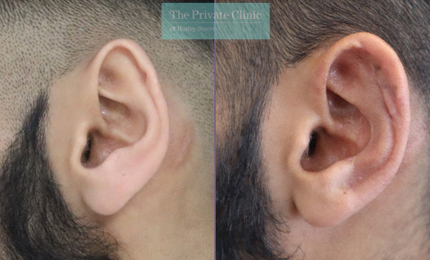 Ear reconstruction before and after results