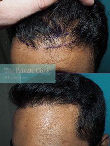 Hair Transplant Revision before and after photos results