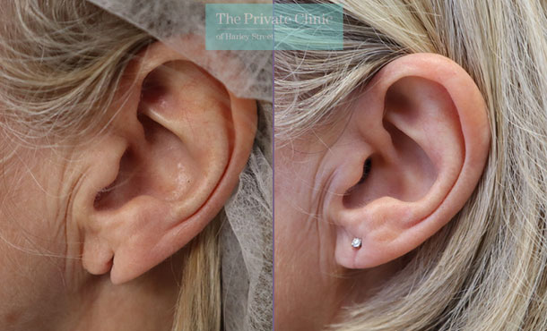 Split Earlobe Repair - 010ML