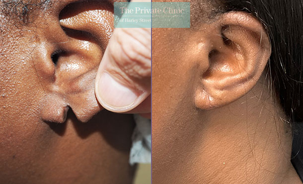 Split Earlobe Repair - 006P-MM