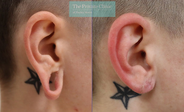 Tribal Earlobe Repair - 011ML