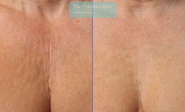 Ultherapy treatment results on the décolletage before after photo