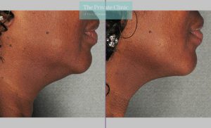 ultherapy necklift skin tightening before after photo