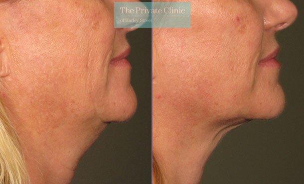 Ultherapy treatment to the neck before after photo