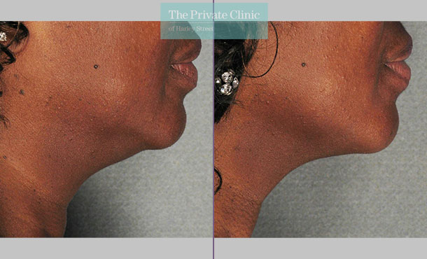 ultherapy necklift non surgical skin tightening leeds before after results