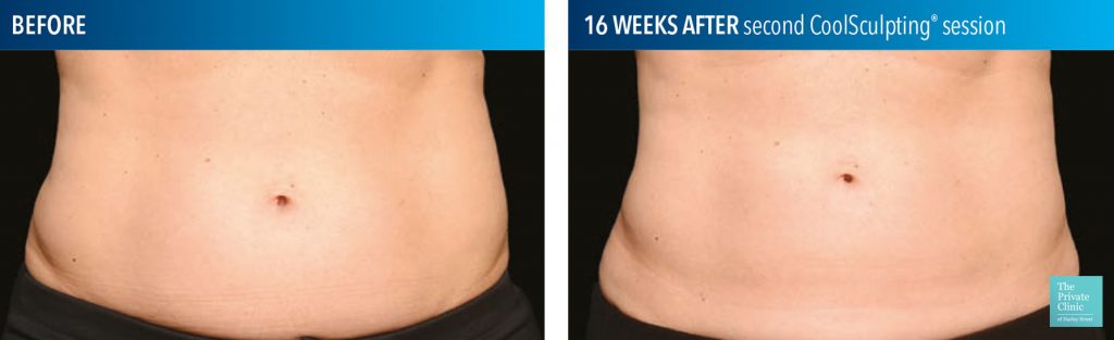 coolsculpting fat freezing results before after photos abdomen tummy stomach birmingham