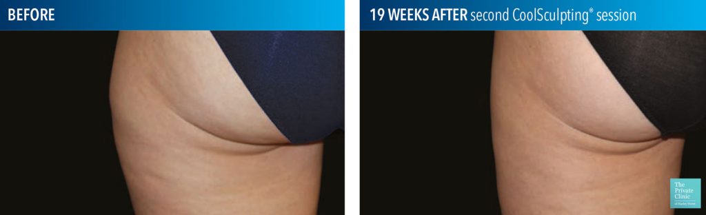 coolsculpting fat freezing results before after photos outer thigh birmingham
