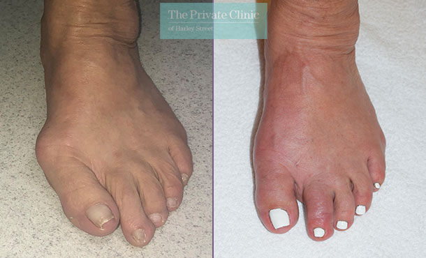 Minimally invasive bunion surgery Manchester before after photo