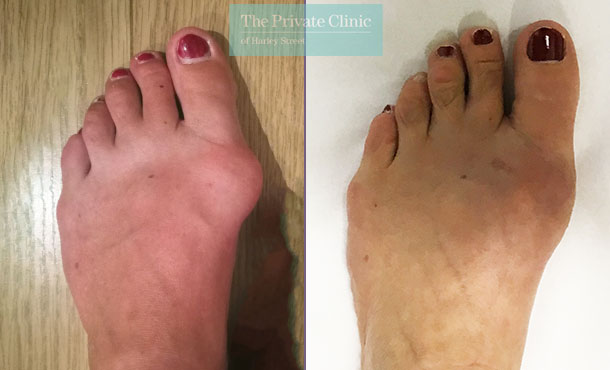Keyhole bunion removal treatment near me Manchester before after photo