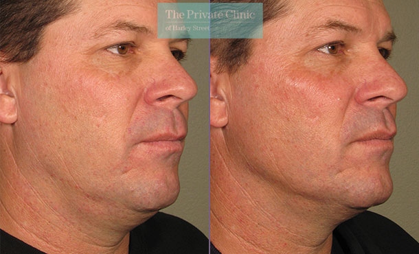 Ultherapy treatment neck lift men before after picture