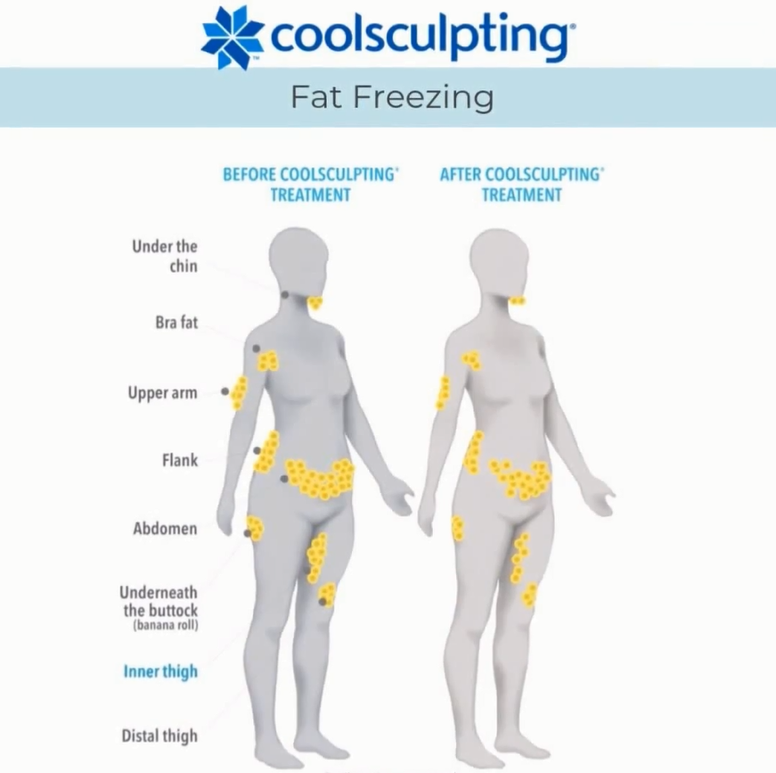 what areas can coolsculpting treat before after fat freezing results birmingham