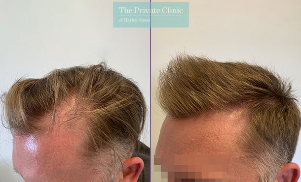 FUE Hair Transplant - 012FR