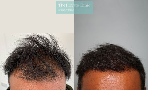 FUE Hair Transplant - 010FR-Front