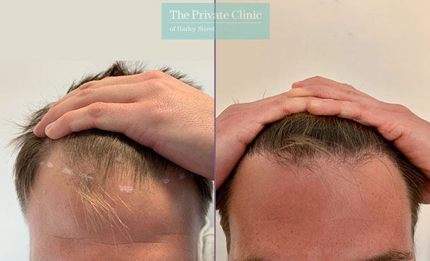 FUE Hair Transplant - 011FR-Front