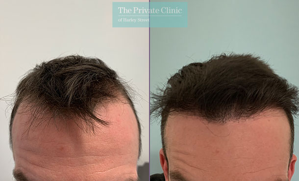 FUE Hair Transplant - 014FR-Front